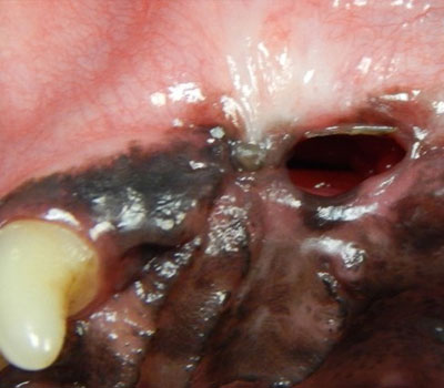 Oral Fistula